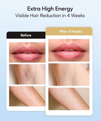 Zeneutic ™ Laser Hair Removal